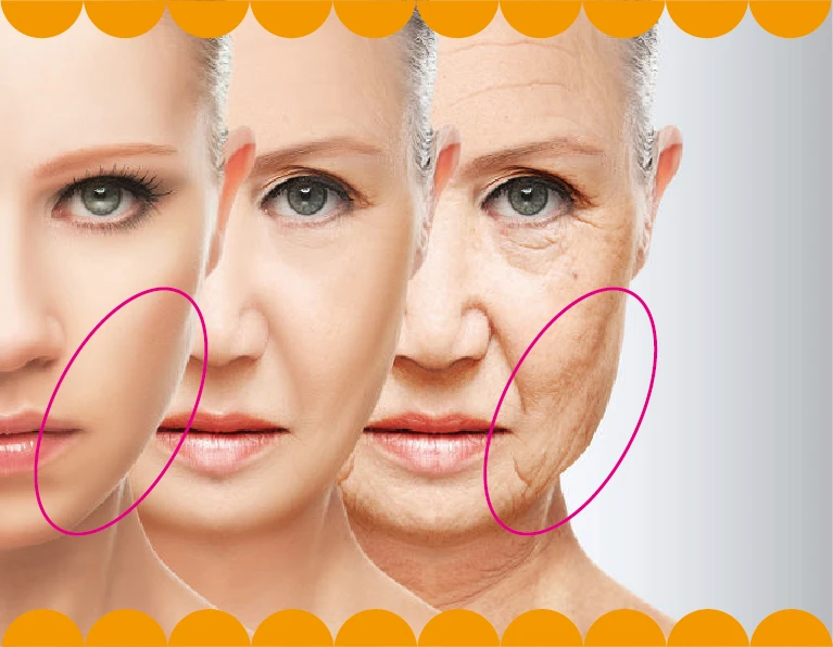 The circled lower-cheek areas illustrate a pronounced lower face.