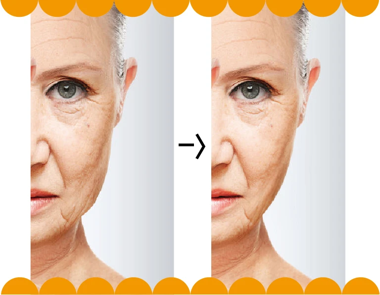 Illustration comparing lower-cheek contours before and after treatment.
