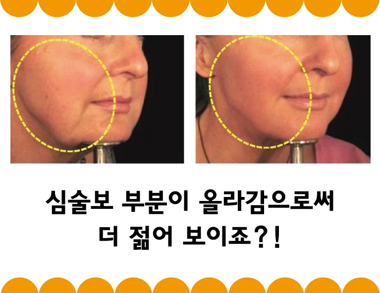 Lifting the jowl area makes the face look younger, doesn’t it?